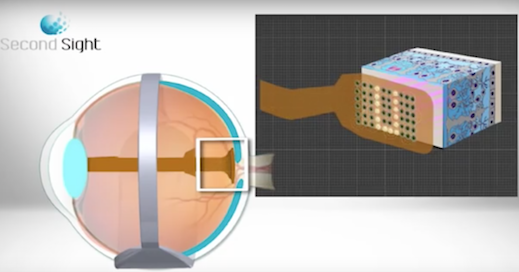 picture of Argus II Bionic Eye